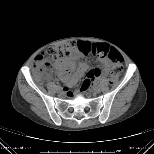 Autosomal dominant polycystic kidney disease (Radiopaedia 44122-47684 Axial non-contrast 88).jpg