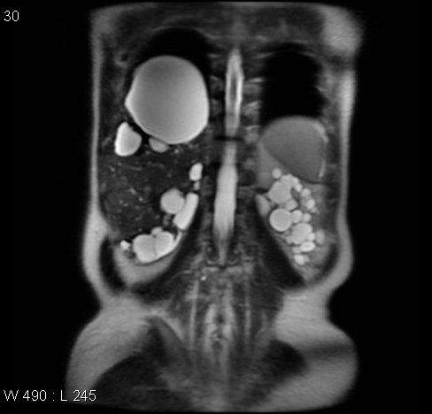 File:Autosomal dominant polycystic kidney disease (Radiopaedia 5202-6969 Coronal T2 12).jpg