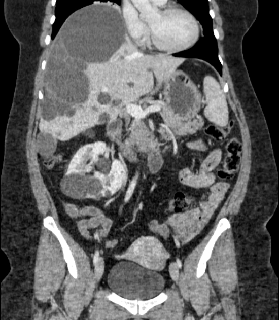 Autosomal dominant polycystic kidney disease (Radiopaedia 57124-64017 B 35).jpg