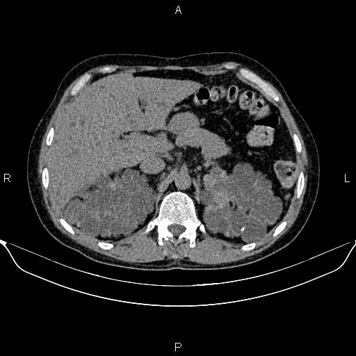 Autosomal dominant polycystic kidney disease (Radiopaedia 87830-104287 Axial non-contrast 17).jpg