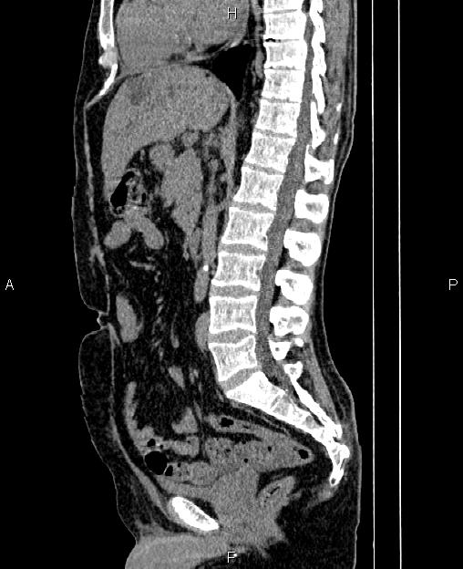 Autosomal dominant polycystic kidney disease (Radiopaedia 87830-104287 C 46).jpg