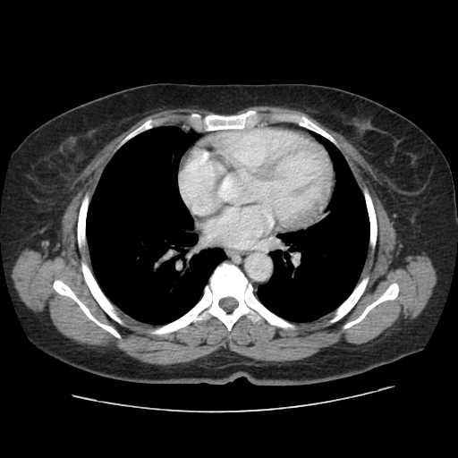 File:Autosomal dominant polycystic kidney disease with hepatic involvement (Radiopaedia 32693-33662 B 1).jpg