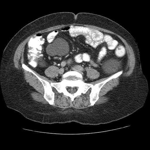 Autosomal dominant polycystic kidney disease with hepatic involvement (Radiopaedia 32693-33662 C 57).jpg