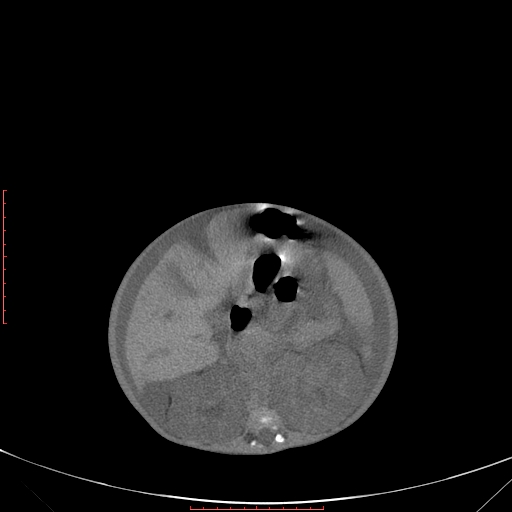 File:Autosomal recessive polycystic kidney disease associated with Caroli disease (Radiopaedia 61932-69984 Axial non-contrast 187).jpg