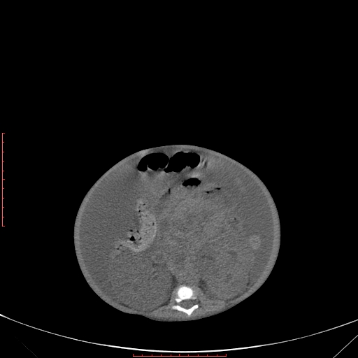 Autosomal recessive polycystic kidney disease associated with Caroli disease (Radiopaedia 61932-69984 Axial non-contrast 221).jpg