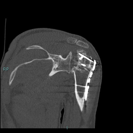 Avascular necrosis after fracture dislocations of the proximal humerus (Radiopaedia 88078-104655 Coronal bone window 73).jpg