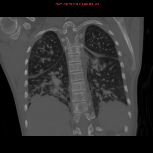 File:Avascular necrosis in sickle cell disease (Radiopaedia 17448-17152 Coronal bone window 92).jpg