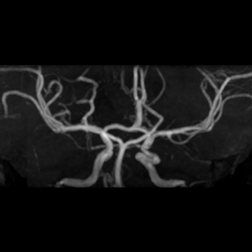 File:Azygos anterior cerebral artery (Radiopaedia 17059-16756 MRA 4).jpg