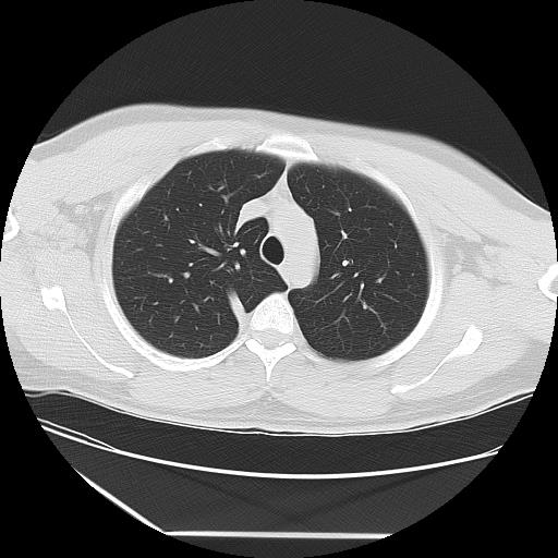 Azygos fissure (Radiopaedia 88181-104784 Axial lung window 12).jpg