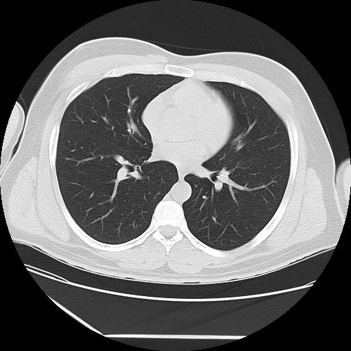 Azygos fissure (Radiopaedia 88181-104784 Axial lung window 28).jpg