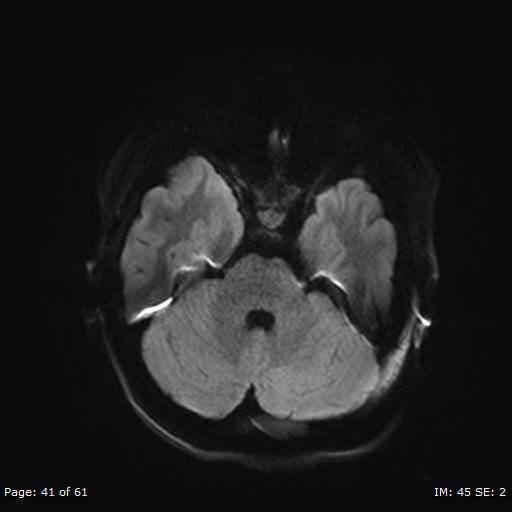 File:Balo concentric sclerosis (Radiopaedia 61637-69636 Axial DWI 41).jpg