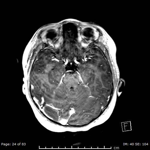 Balo concentric sclerosis (Radiopaedia 61637-69636 Axial T1 C+ 24).jpg