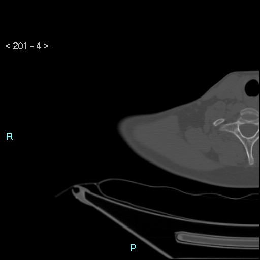 Bankart lesion with glenoid bone defect - assessment TC with PICO method (Radiopaedia 42855-93901 Axial bone window 3).jpg