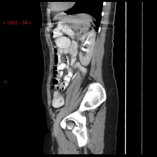 File:Bartholin gland cyst (Radiopaedia 54904-61181 Sagittal C+ delayed 34).jpg