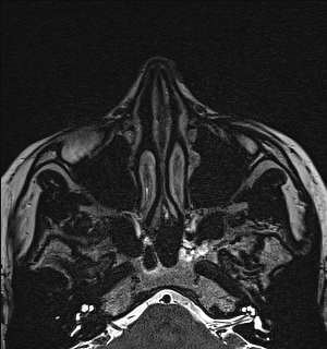 Basal cell carcinoma - nasal region (Radiopaedia 70292-80365 Axial Gradient Echo 34).jpg