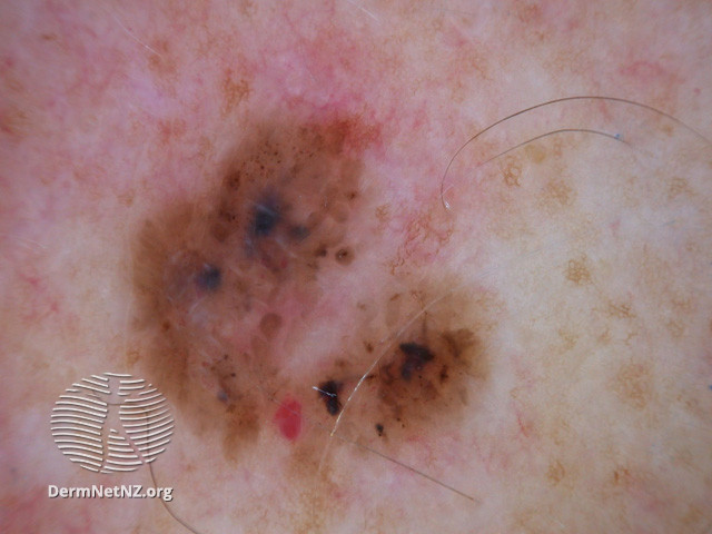 File:Basal cell carcinoma affecting the face (DermNet NZ lesions-bcc-face-0805).jpg