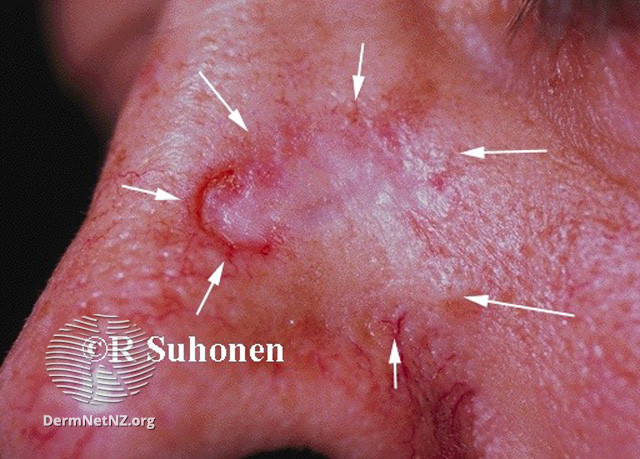 File:Basal cell carcinoma affecting the nose (DermNet NZ lesions-bcc-nose-0650).jpg