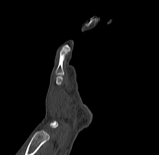 Base of 2nd metacarpal fracture (Radiopaedia 73741-84544 Coronal bone window 21).jpg