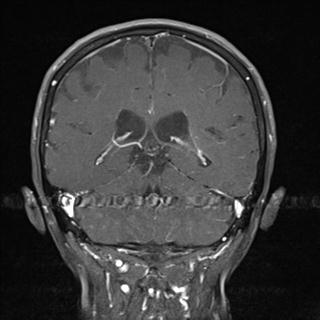 File:Base of skull chondrosarcoma (Radiopaedia 30410-31070 G 18).jpg