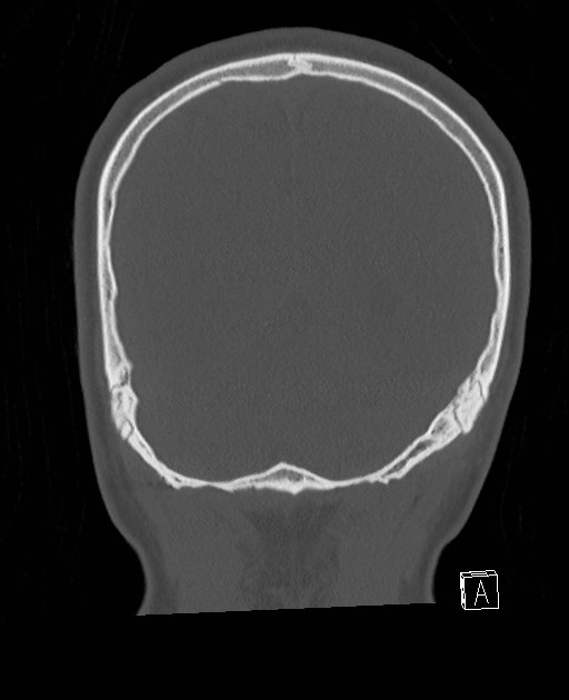 Base of skull fracture with bilateral Le Fort fractures (Radiopaedia 47094-51638 Coronal bone window 21).jpg