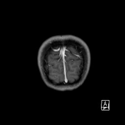 Base of skull rhabdomyosarcoma (Radiopaedia 32196-33142 I 69).jpg