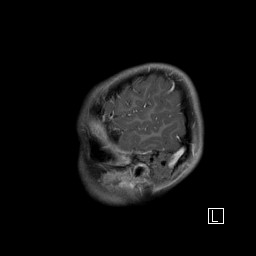Base of skull rhabdomyosarcoma (Radiopaedia 32196-33142 J 10).jpg