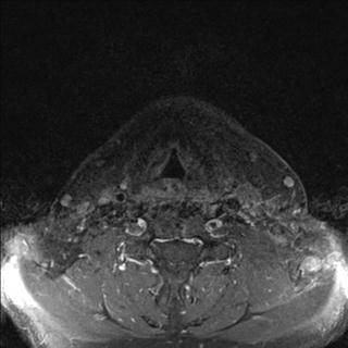 File:Base of tongue squamous cell carcinoma (Radiopaedia 31174-31884 Axial T1 C+ fat sat 4).jpg
