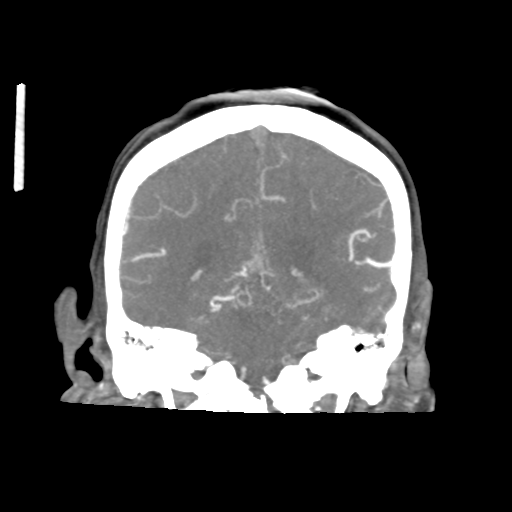 Basilar and bilateral vertebral artery occlusion (Radiopaedia 45592-49723 B 65).png