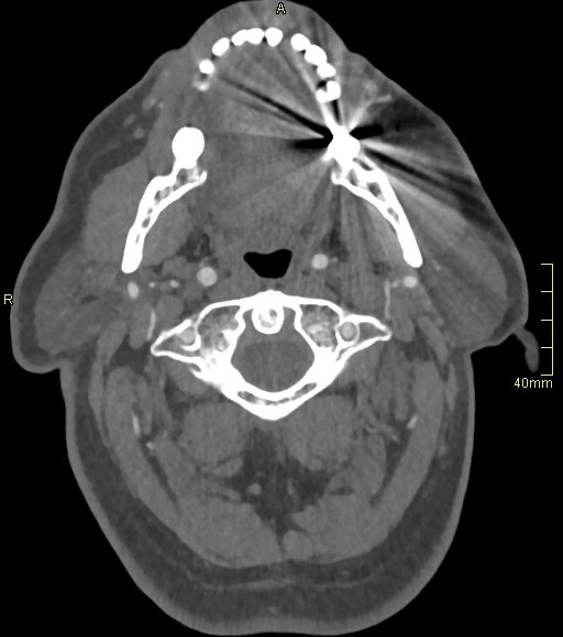 Basilar artery aneurysm (Radiopaedia 56261-62932 A 25).jpg