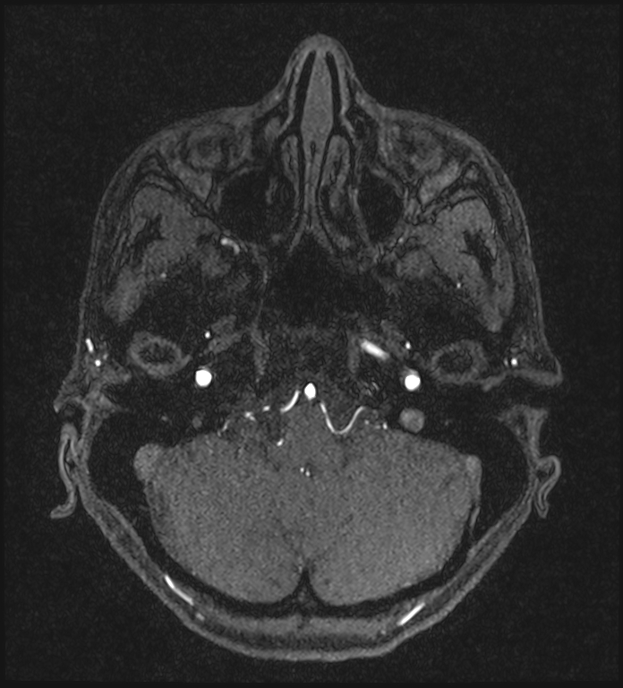 Basilar artery perforator aneurysm (Radiopaedia 82455-97733 Axial MRA 51).jpg