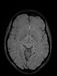 File:Basilar artery perforator aneurysm (Radiopaedia 82455-97733 Axial SWI 26).jpg