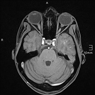 Basilar artery perforator aneurysm (Radiopaedia 82455-99523 F 40).jpg