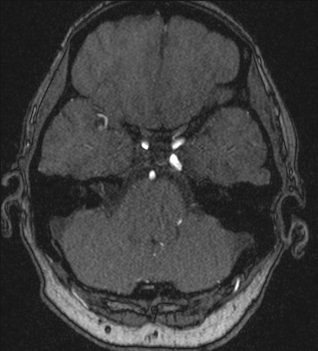 Basilar tip aneurysm (Radiopaedia 26504-26632 MRA 56).jpg
