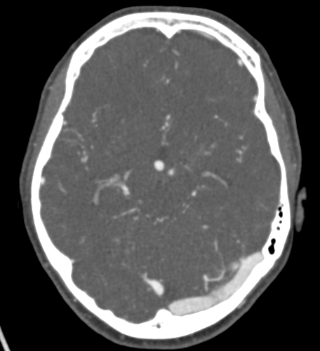 Basilar tip aneurysm with coiling (Radiopaedia 53912-60086 A 64).jpg