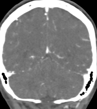 Basilar tip aneurysm with coiling (Radiopaedia 53912-60086 B 118).jpg