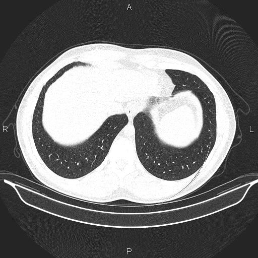 Beam hardening and ring artifacts (Radiopaedia 85323-100915 Axial lung window 64).jpg