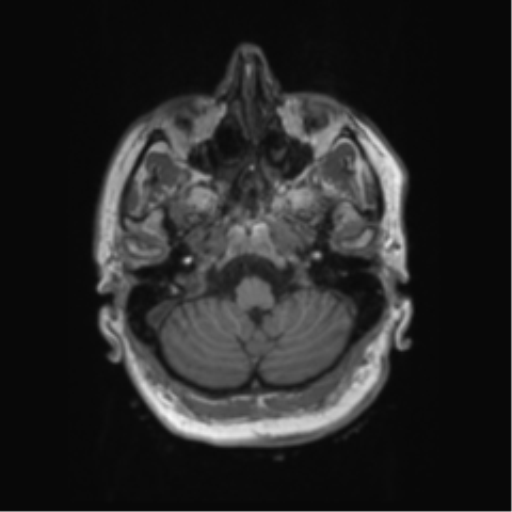 File:Behavioral variant frontotemporal dementia and late onset schizophrenia (Radiopaedia 52197-58083 Axial T1 94).png