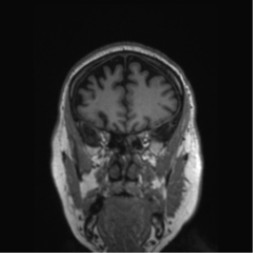 Behavioral variant frontotemporal dementia and late onset schizophrenia (Radiopaedia 52197-58083 Coronal T1 69).png