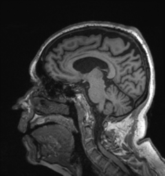 Behavioral variant frontotemporal dementia and late onset schizophrenia (Radiopaedia 52197-58083 Sagittal T1 56).png