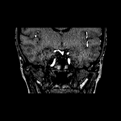 Berry aneurysm of the terminal internal carotid artery (Radiopaedia 88286-104918 Coronal TOF 45).jpg