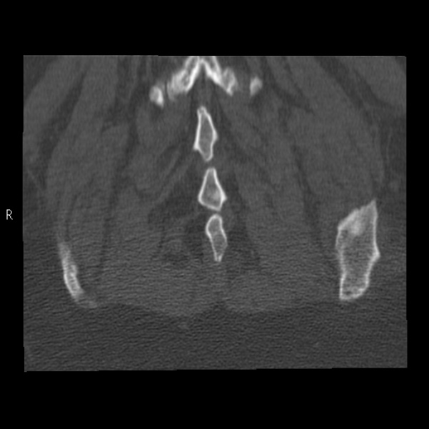 Bertolotti syndrome (Radiopaedia 24864-25128 Coronal bone window 45).jpg
