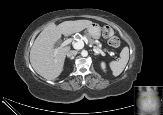 Bicameral celiacomesenteric aneurysm (Radiopaedia 55766-62327 A 19).jpg