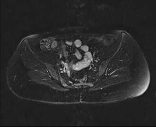 File:Bicornuate bicollis uterus (Radiopaedia 61626-69616 Axial PD fat sat 12).jpg