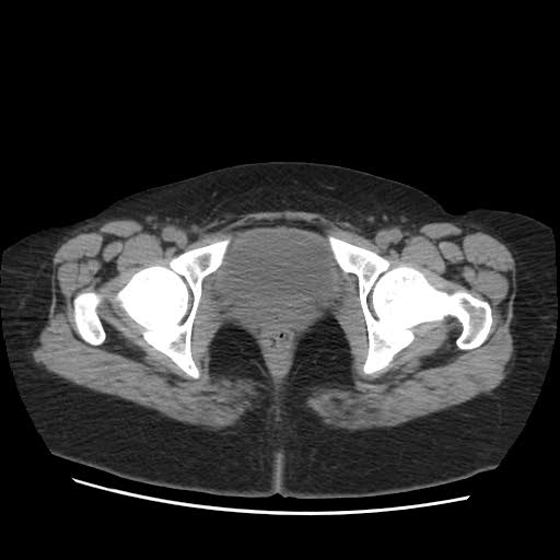 File:Bicornuate uterus- on MRI (Radiopaedia 49206-54296 Axial non-contrast 13).jpg