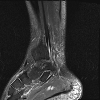 File:Bilateral Achilles tendon complete tear (Radiopaedia 81344-95051 Sagittal T2 fat sat 18).jpg