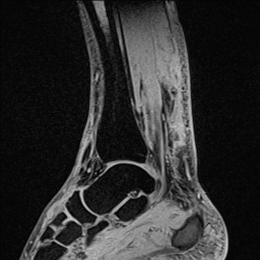 Bilateral Achilles tendon complete tear (Radiopaedia 81344-95051 Sagittal WE - Right 67).jpg