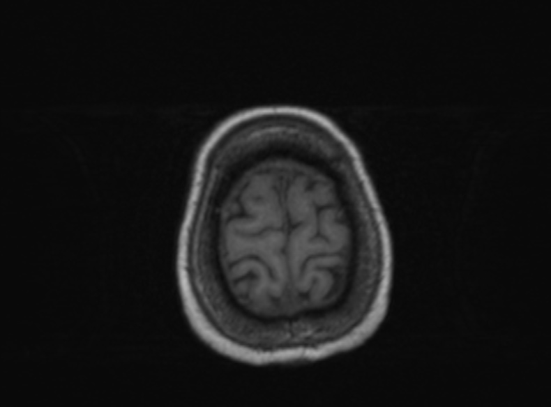 File:Bilateral PCA territory infarction - different ages (Radiopaedia 46200-51784 Axial T1 129).jpg