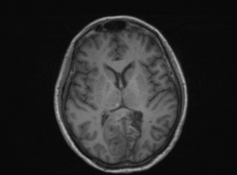 Bilateral PCA territory infarction - different ages (Radiopaedia 46200-51784 Axial T1 228).jpg