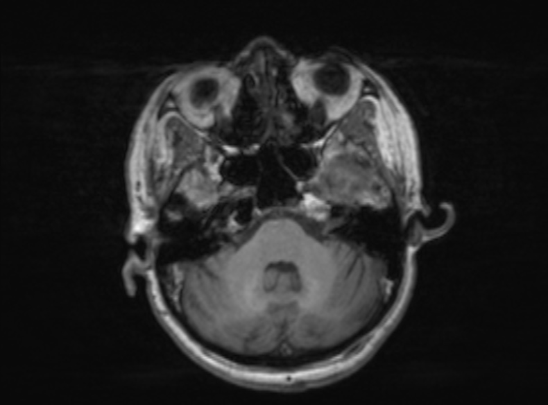 Bilateral PCA territory infarction - different ages (Radiopaedia 46200-51784 Axial T1 304).jpg