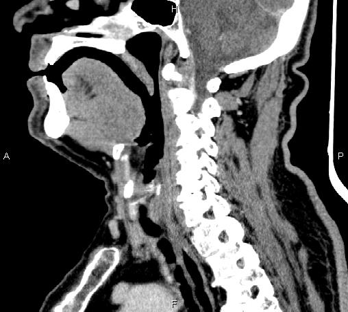 Bilateral Warthin tumors (Radiopaedia 84034-99263 D 44).jpg